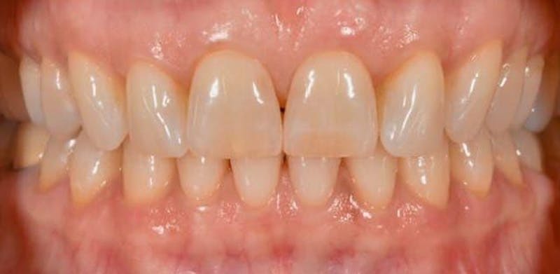 Smile Before & After Gallery - Patient 43748170 - Image 1