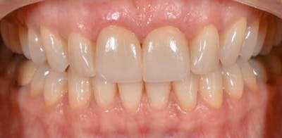 Smile Before & After Gallery - Patient 43748170 - Image 2