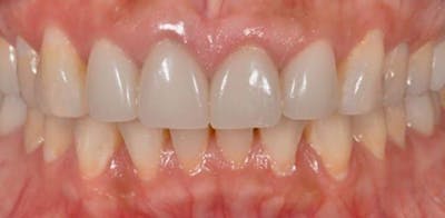 Smile Before & After Gallery - Patient 43748172 - Image 1