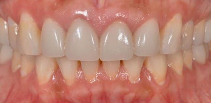 Smile Before & After Gallery - Patient 43748172 - Image 1