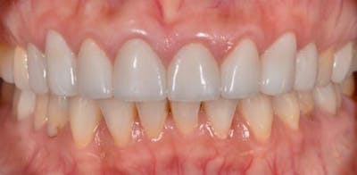 Smile Before & After Gallery - Patient 43748172 - Image 2