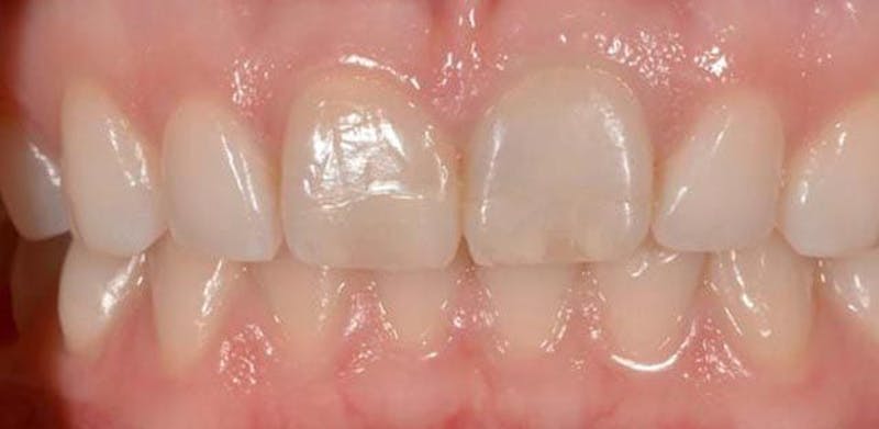Smile Before & After Gallery - Patient 43748174 - Image 1