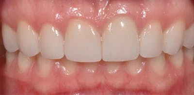Smile Before & After Gallery - Patient 43748174 - Image 2