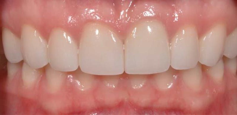 Smile Before & After Gallery - Patient 43748174 - Image 2