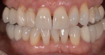 Smile Before & After Gallery - Patient 43748177 - Image 1