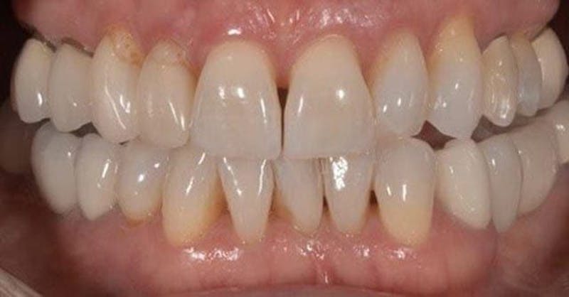 Smile Before & After Gallery - Patient 43748177 - Image 1