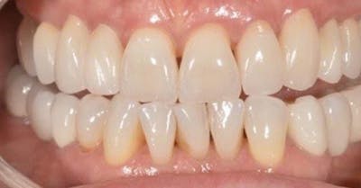 Smile Before & After Gallery - Patient 43748177 - Image 2