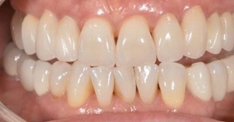 Smile Before & After Gallery - Patient 43748177 - Image 2