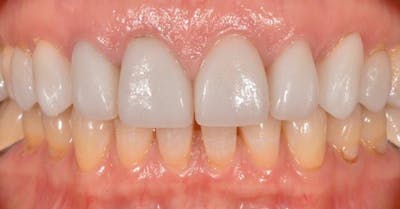 Smile Before & After Gallery - Patient 43748180 - Image 1