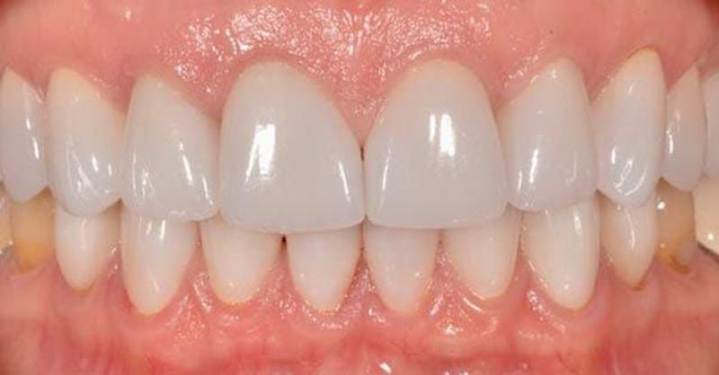 Smile Before & After Gallery - Patient 43748180 - Image 2