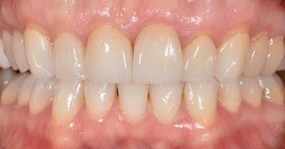 Smile Before & After Gallery - Patient 43748181 - Image 1