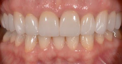 Smile Before & After Gallery - Patient 43748181 - Image 2