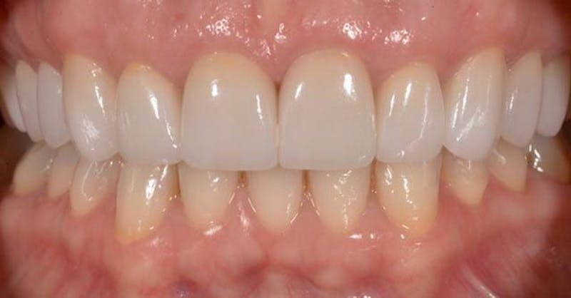 Smile Before & After Gallery - Patient 43748181 - Image 2