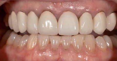 Smile Before & After Gallery - Patient 43748182 - Image 1