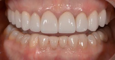 Smile Before & After Gallery - Patient 43748182 - Image 2