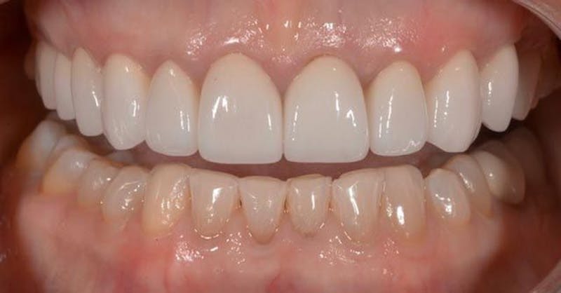 Smile Before & After Gallery - Patient 43748182 - Image 2
