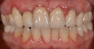 Smile Before & After Gallery - Patient 43748184 - Image 1