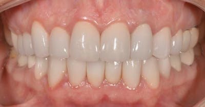 Smile Before & After Gallery - Patient 43748184 - Image 2