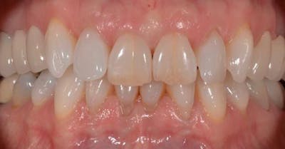 Smile Before & After Gallery - Patient 43748187 - Image 1
