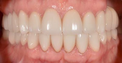 Smile Before & After Gallery - Patient 43748187 - Image 2