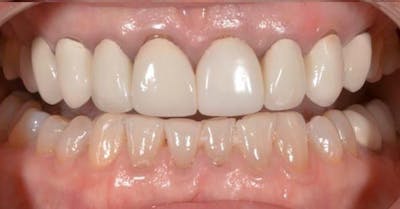 Smile Before & After Gallery - Patient 43748189 - Image 1
