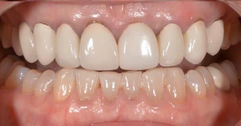 Smile Before & After Gallery - Patient 43748189 - Image 1