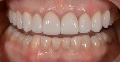 Smile Before & After Gallery - Patient 43748189 - Image 2
