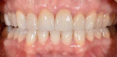 Smile Before & After Gallery - Patient 43748193 - Image 1