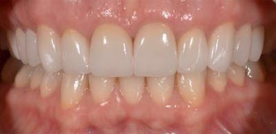 Smile Before & After Gallery - Patient 43748193 - Image 2
