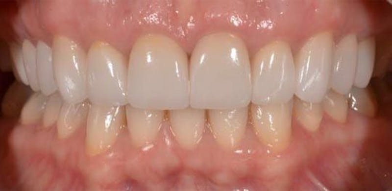 Smile Before & After Gallery - Patient 43748193 - Image 2