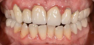 Smile Before & After Gallery - Patient 43748196 - Image 1