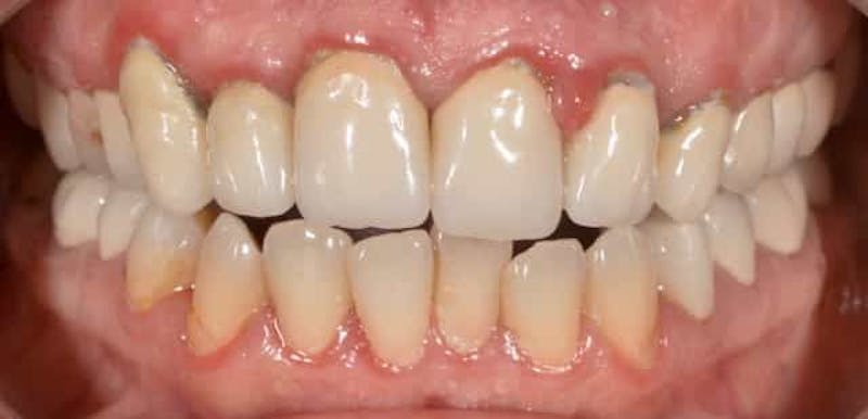 Smile Before & After Gallery - Patient 43748196 - Image 1