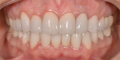 Smile Before & After Gallery - Patient 43748196 - Image 2