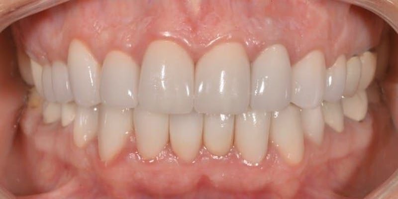 Smile Before & After Gallery - Patient 43748196 - Image 2