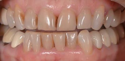 Smile Before & After Gallery - Patient 43748198 - Image 1