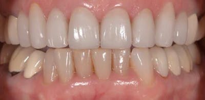 Smile Before & After Gallery - Patient 43748198 - Image 2