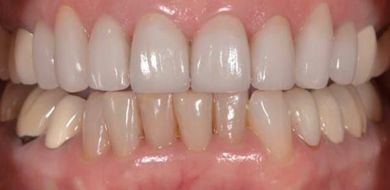 Smile Before & After Gallery - Patient 43748198 - Image 2