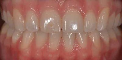 Smile Before & After Gallery - Patient 43748199 - Image 1