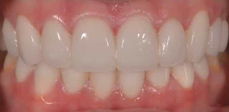 Smile Before & After Gallery - Patient 43748199 - Image 2
