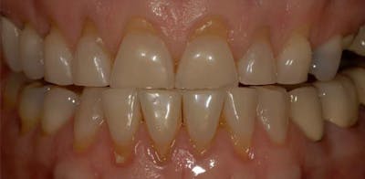 Smile Before & After Gallery - Patient 43748200 - Image 1
