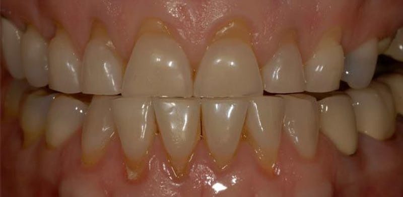 Smile Before & After Gallery - Patient 43748200 - Image 1