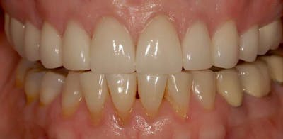 Smile Before & After Gallery - Patient 43748200 - Image 2