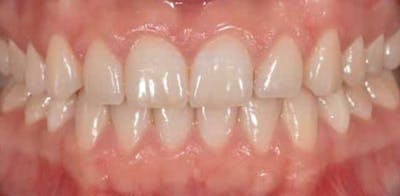 Smile Before & After Gallery - Patient 43748201 - Image 1