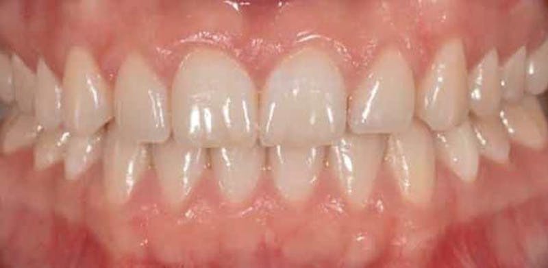 Smile Before & After Gallery - Patient 43748201 - Image 1