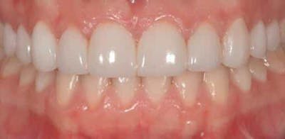 Smile Before & After Gallery - Patient 43748201 - Image 2