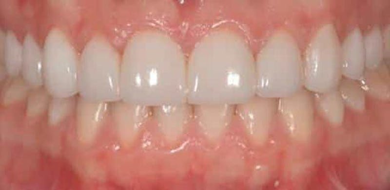 Smile Before & After Gallery - Patient 43748201 - Image 2