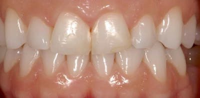Smile Before & After Gallery - Patient 43748202 - Image 1