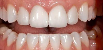 Smile Before & After Gallery - Patient 43748202 - Image 2