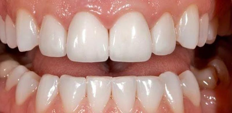 Smile Before & After Gallery - Patient 43748202 - Image 2