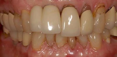 Smile Before & After Gallery - Patient 43748204 - Image 1